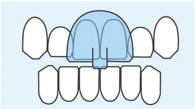 Overland Park Dentists can assist in migraine appliance fitting