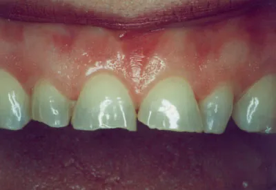 Porcelain Veneers